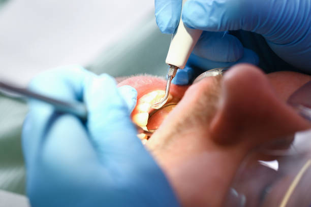 Best Emergency Treatment for Dental Infections or Abscesses in Bakersfield Country Clu, CA
