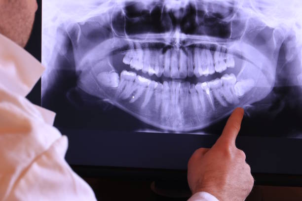 Best Emergency Wisdom Teeth Removal in Bakersfield Country Clu, CA